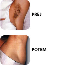 poraščenost pazduhe